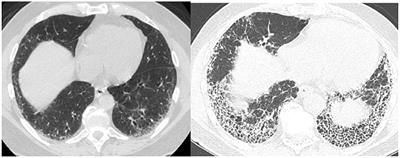 The Role of Radiology in Progressive Fibrosing Interstitial Lung Disease